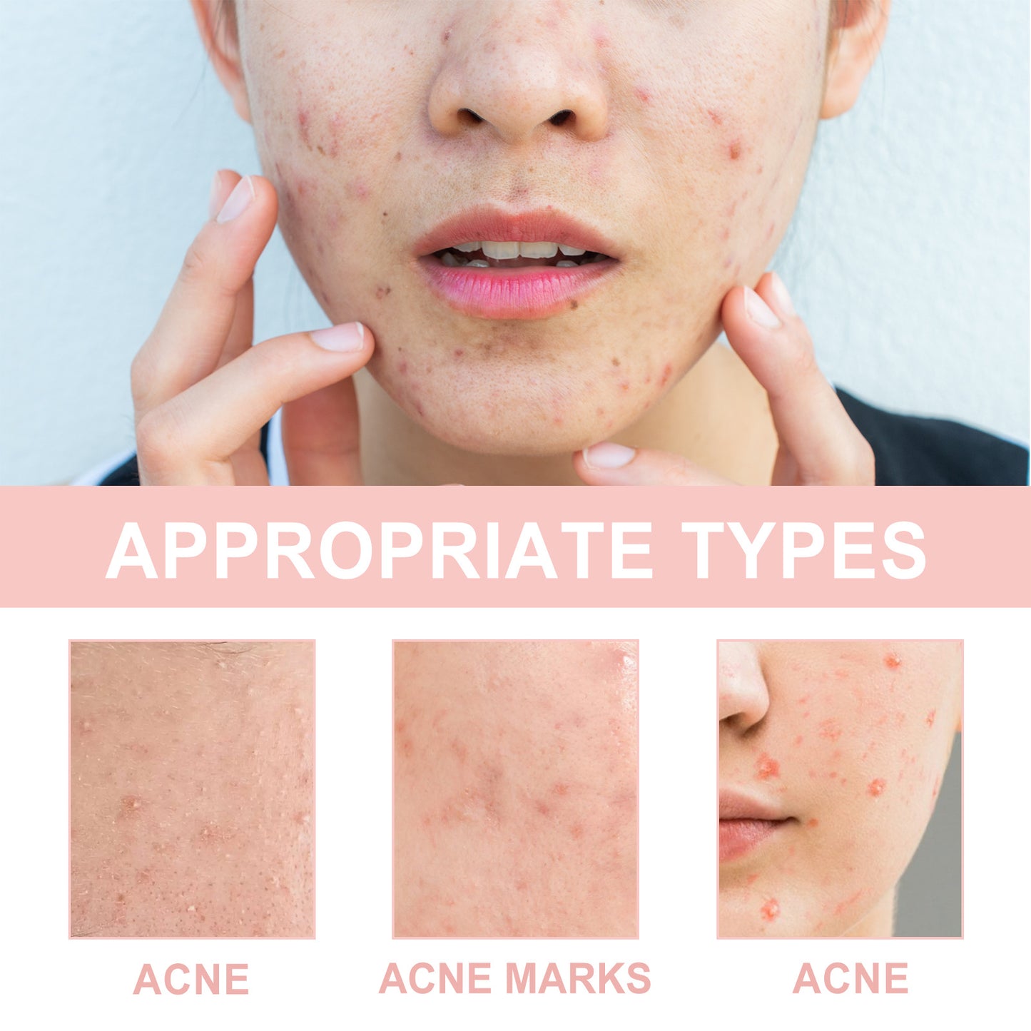OUHOE Acne Patch Repair Acne Acne Redness Pore Cleansing & Moisturizing Patch - EZ Beauty Lashes