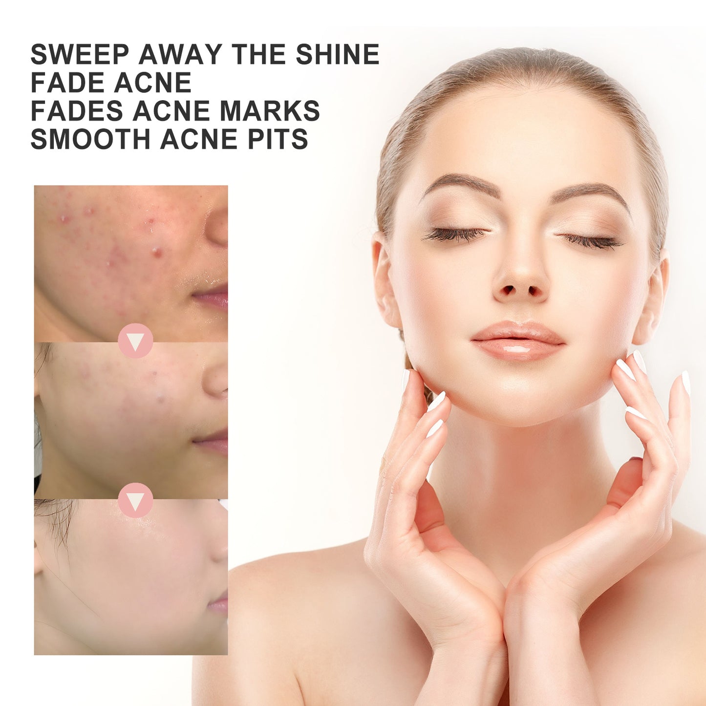 OUHOE Acne Patch Repair Acne Acne Redness Pore Cleansing & Moisturizing Patch - EZ Beauty Lashes